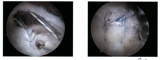 rotator cuff repair